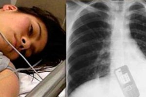 raio-x da menina -  reprodução internet 