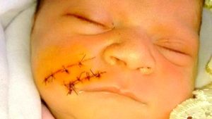 Cesárea deixa rosto de bebê cortado após parto de emergência